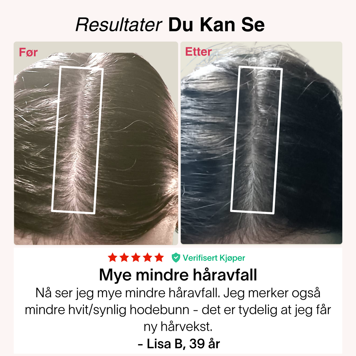 Hårvekst-Pakken PRO – bilde 8