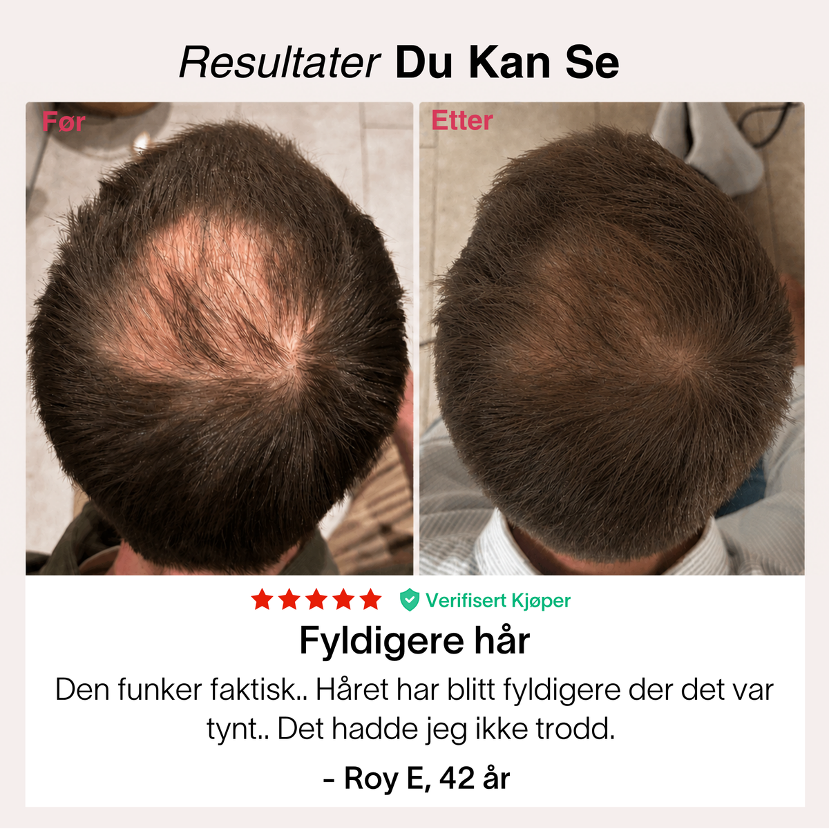 Hårvekst-Pakken – bilde 4
